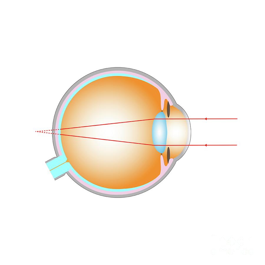 Long Sightedness Photograph by Cordelia Molloy/science Photo Library ...