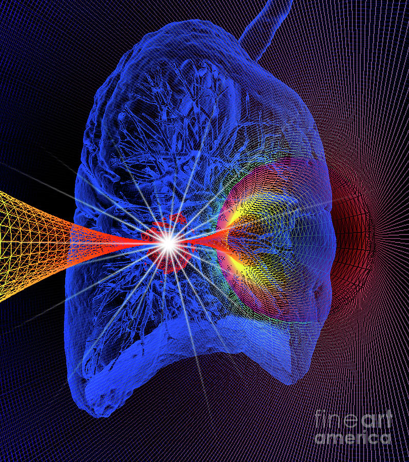 Lung Cancer Radiotherapy #1 Photograph by K H Fung/science Photo Library