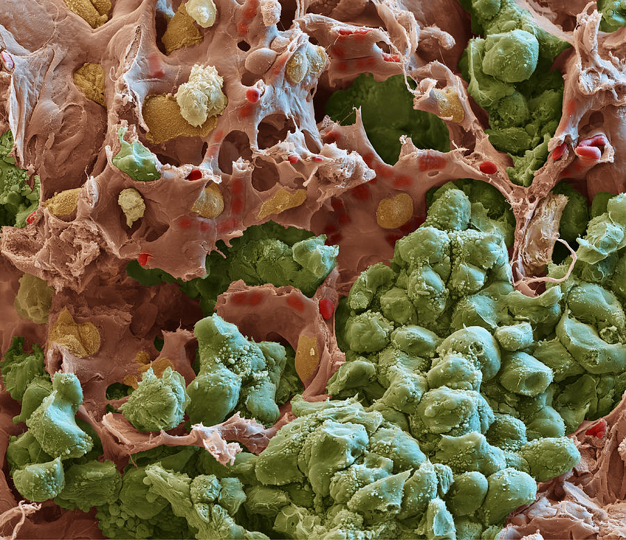 Lung Cancer, Sem #1 Photograph by Meckes/ottawa