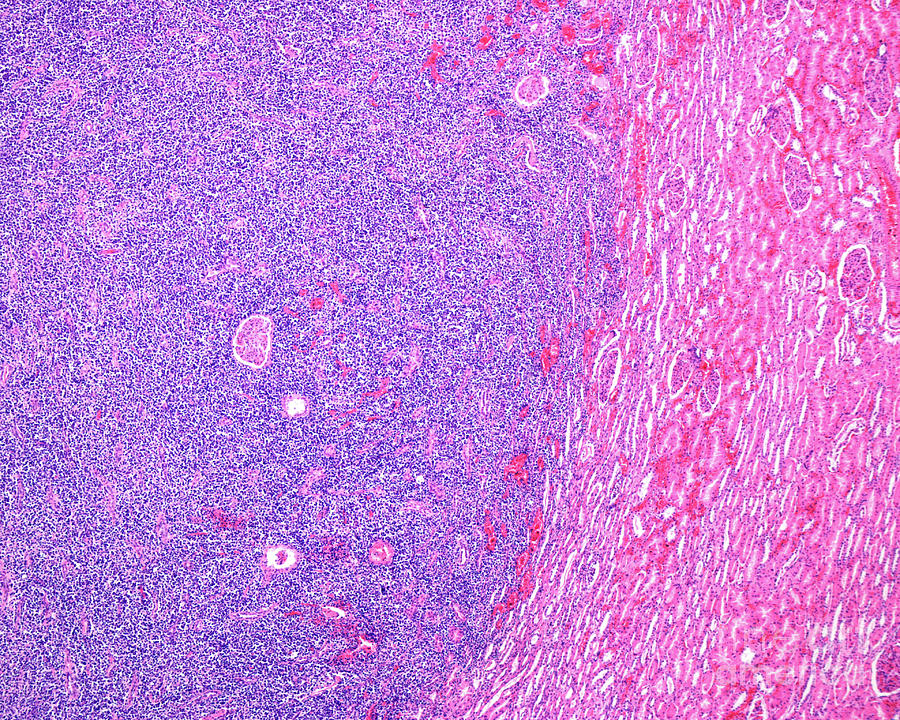 Lymphosarcoma In Human Kidney Photograph by Jose Calvo / Science Photo ...