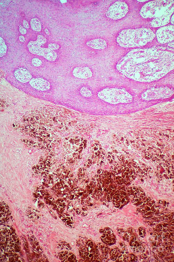Malignant Melanoma #1 Photograph by Steve Gschmeissner/science Photo Library