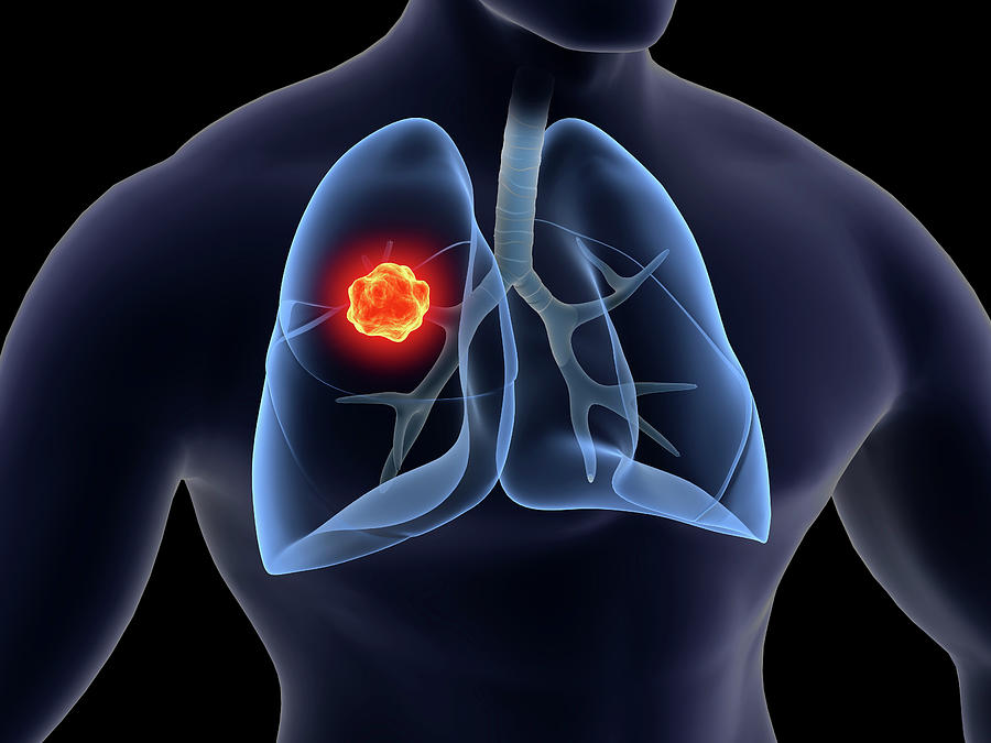 Medical Illustration Of Lung Cancer #1 Photograph by Stocktrek Images