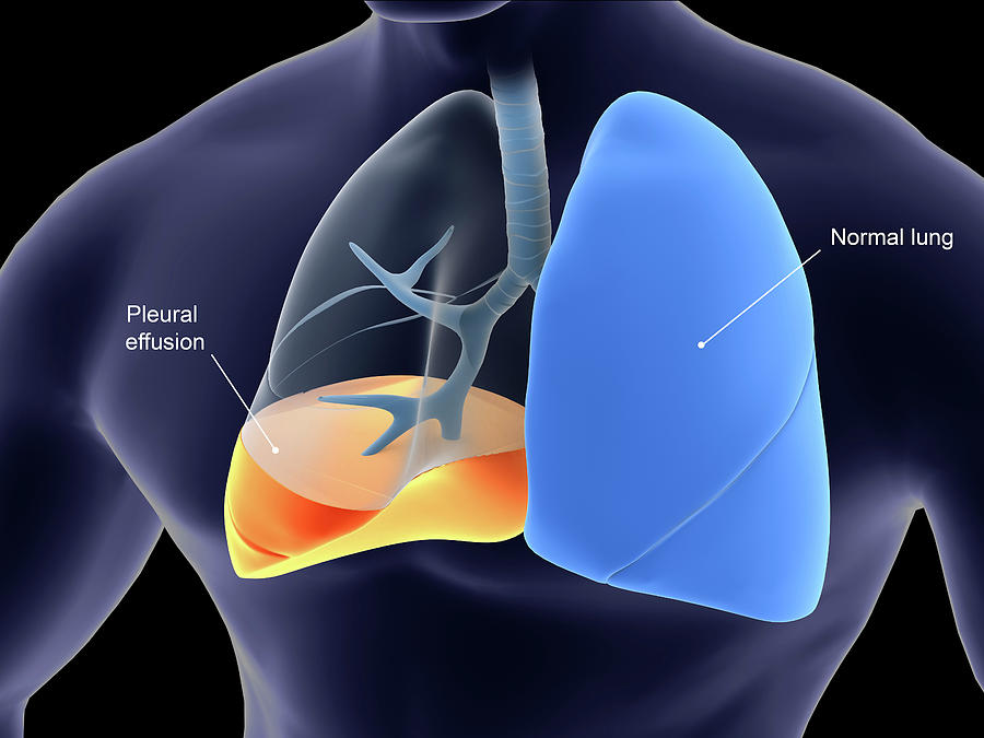 Medical Illustration Showing Pleurisy #1 Photograph by Stocktrek Images