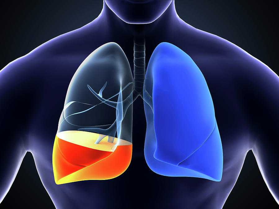 Medical Illustration Showing Pneumonia Photograph by Stocktrek Images ...