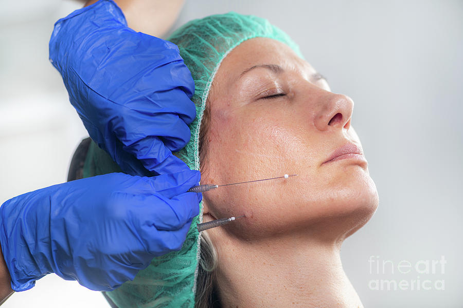 Mesotherapy Thread Face Lift Procedure #1 Photograph by Microgen Images/science Photo Library