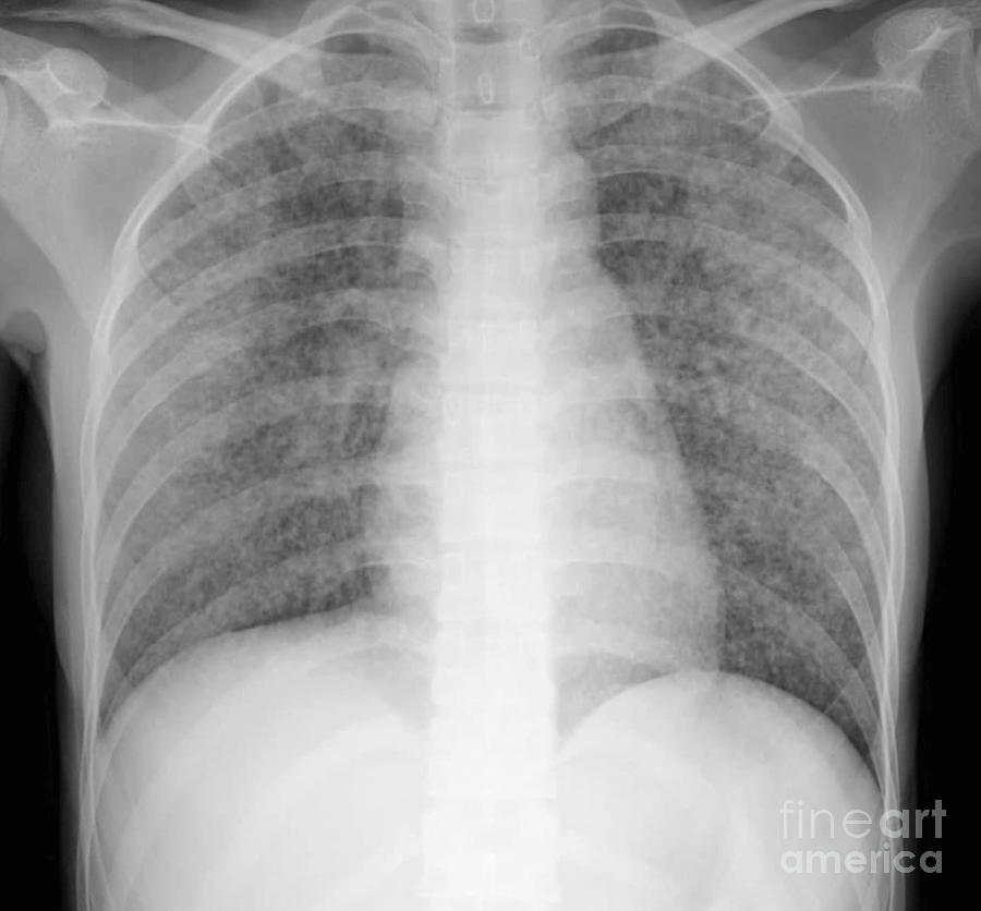 Chest X Ray Miliary Tb