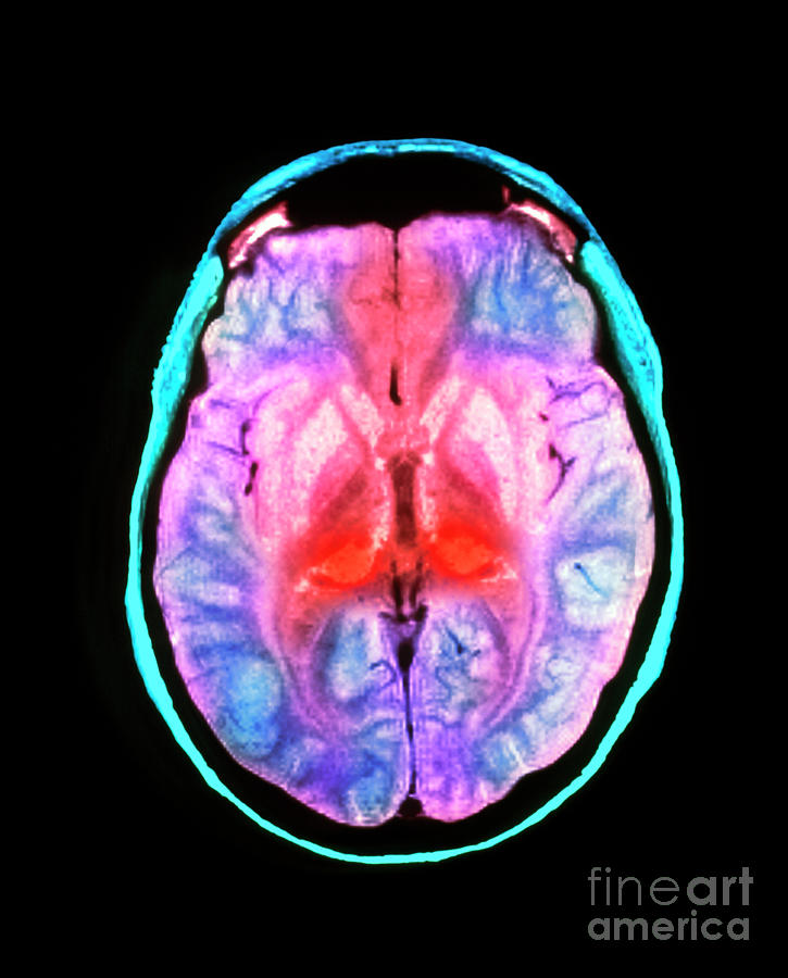 Mri Scan Of Human Brain Diseased With Cjd Photograph by Simon Fraser ...