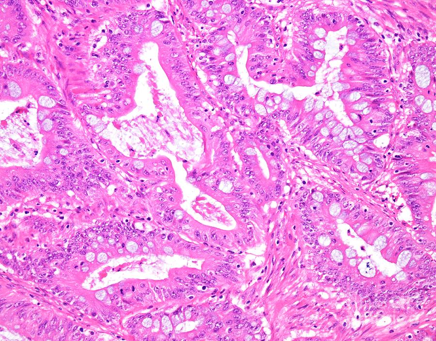 Mucinous Carcinoma Of The Colon Photograph by Webpathology/science ...