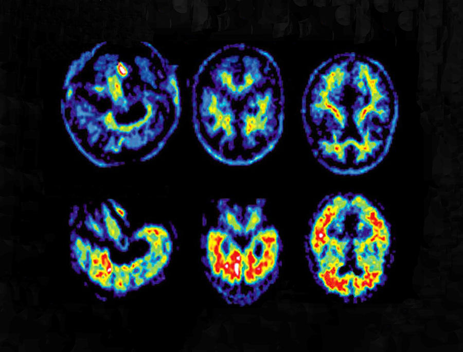 Normal And Alzheimer Brains, Pet Scans #1 Photograph by Science Source