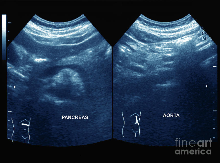 Normal Pancreas And Aorta Photograph By Zephyr Science Photo Library Fine Art America