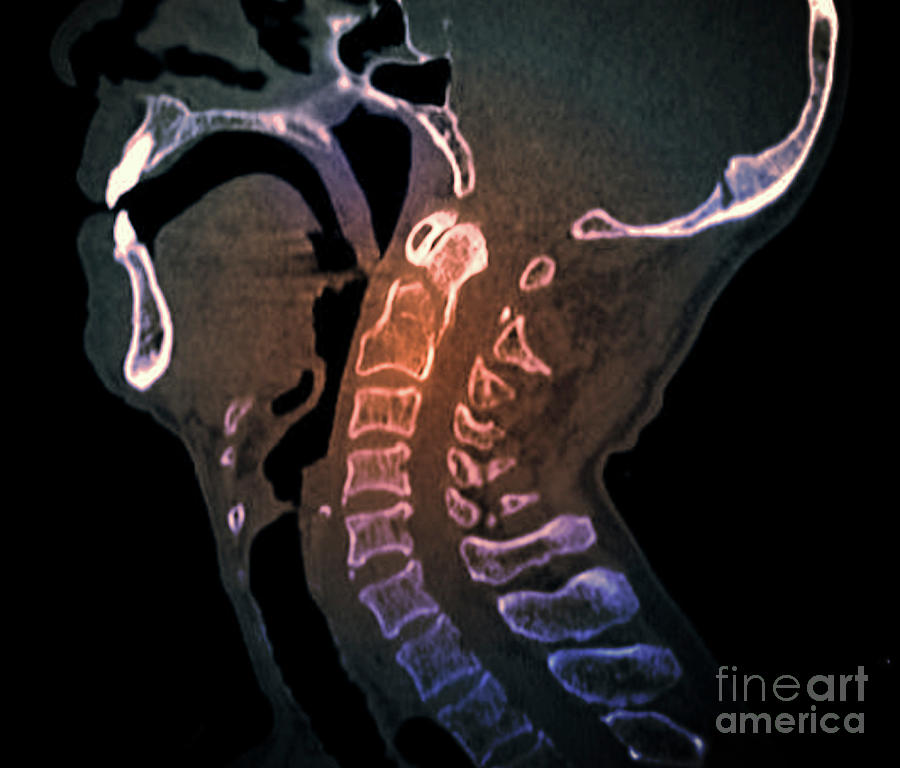 Odontoid Process Fracture #1 Photograph by Zephyr/science Photo Library