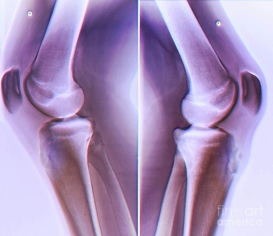 Osgood-schlatter Disease #1 Photograph by Zephyr/science Photo Library