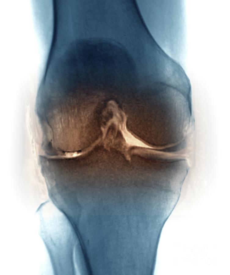 Osteoarthritis Of The Knee Joint #1 Photograph by Zephyr/science Photo Library