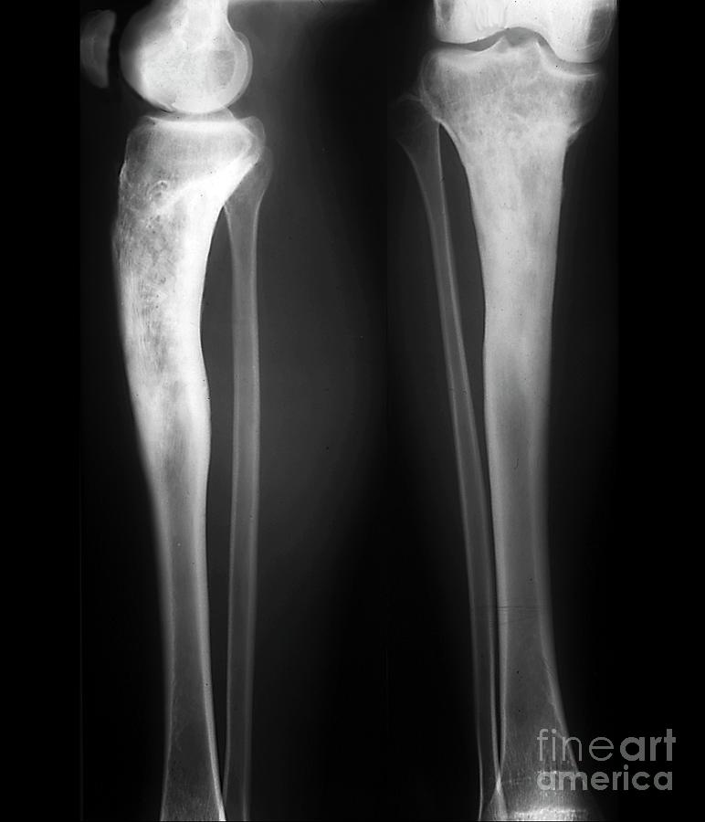 Osteomyelitis In The Lower Leg #1 by Zephyr/science Photo Library