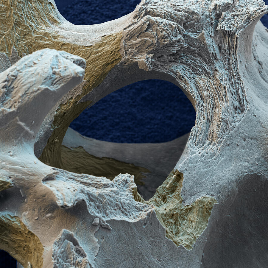 Osteoporotic Bone #1 Photograph by Meckes/ottawa
