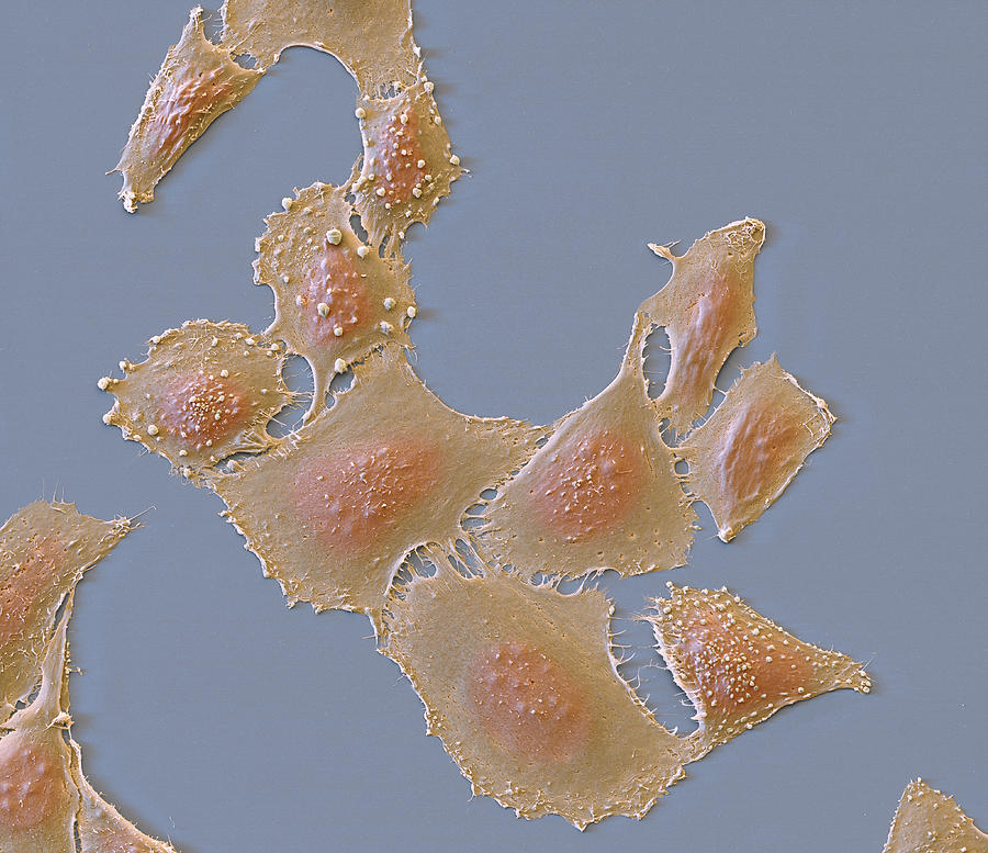 Bone Cancer Photograph - Osteosarcoma Cells, Sem #1 by Meckes/ottawa
