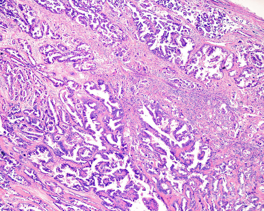 Ovarian Mucinous Cystadenocarcinoma 1 By Jose Calvo Science Photo Library 9377