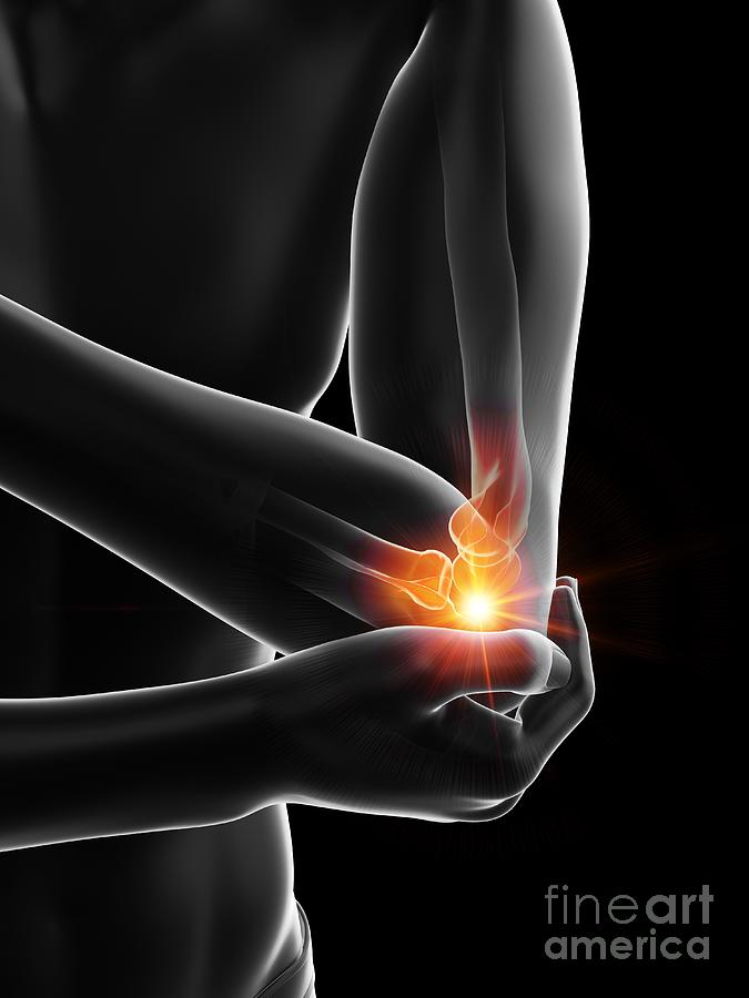 Painful Elbow #1 Photograph by Sebastian Kaulitzki/science Photo Library