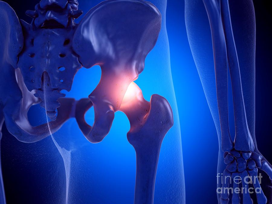 Painful Hip Joint #1 Photograph by Sebastian Kaulitzki/science Photo Library