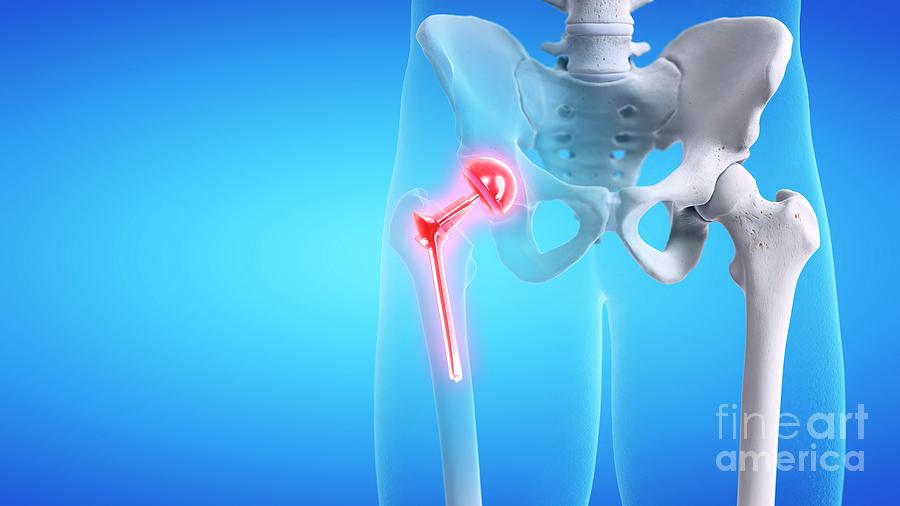 Painful Hip Replacement #1 Photograph by Sebastian Kaulitzki/science Photo Library