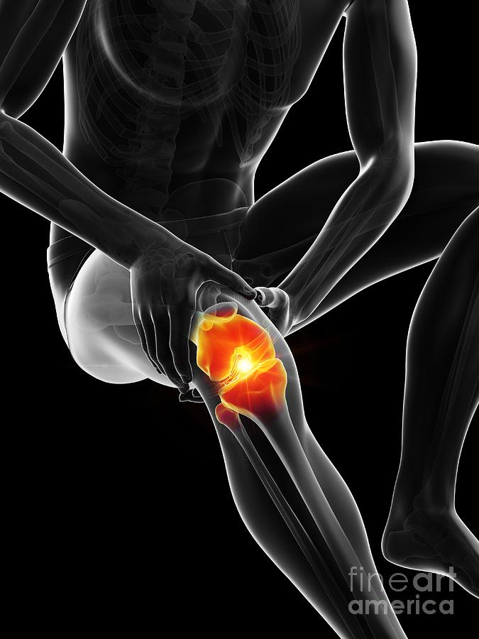 Painful Knee #1 Photograph by Sebastian Kaulitzki/science Photo Library