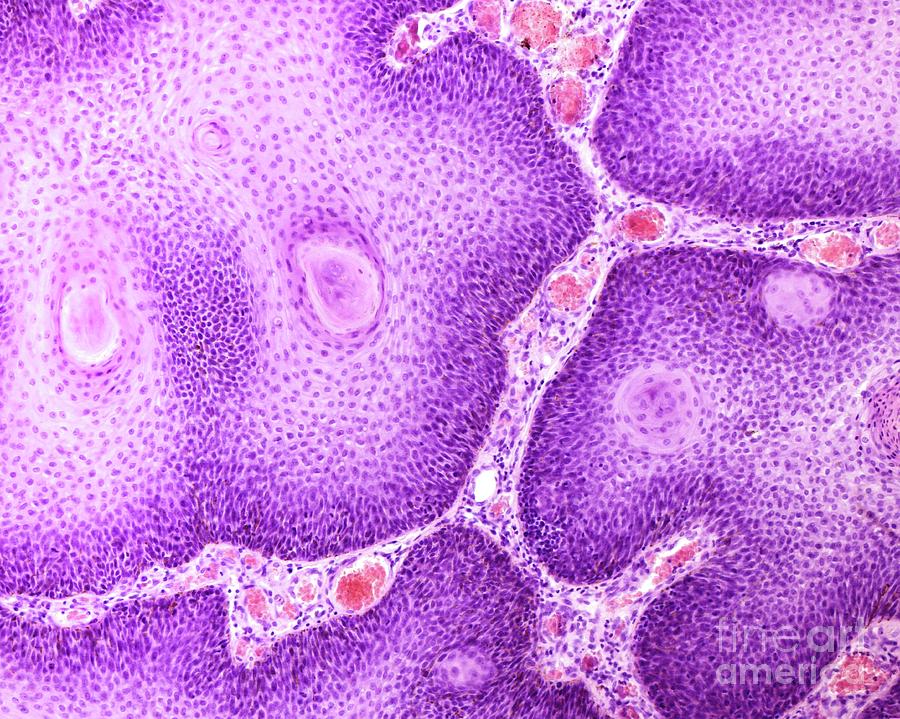 Papilloma Of The Larynx 1 By Jose Calvo Science Photo Library