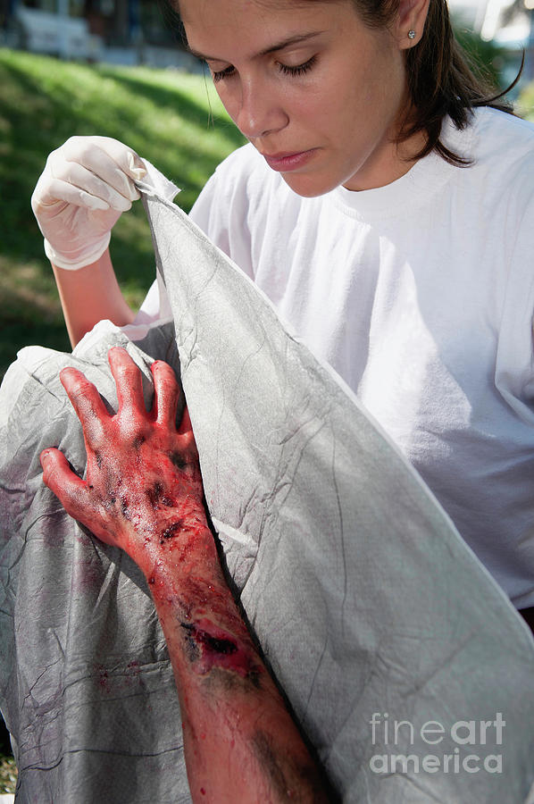 Paramedic Treating A Victim With Third Degree Burns #1 Photograph by Microgen Images/science Photo Library