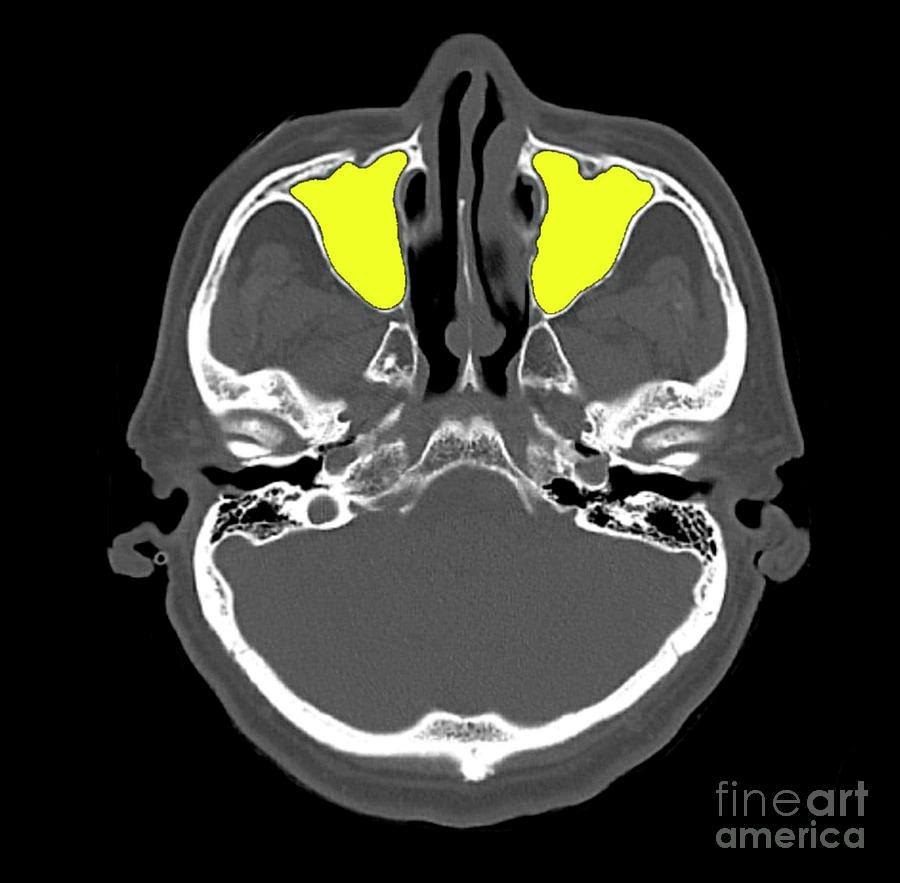 Paranasal Sinus Anatomy Photograph by Rajaaisya/science Photo Library ...