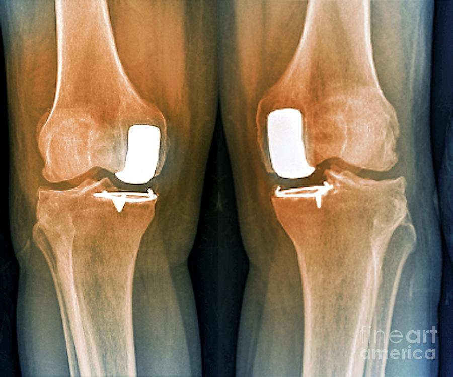 Partial Knee Replacement Photograph By Zephyr Science Photo Library Fine Art America