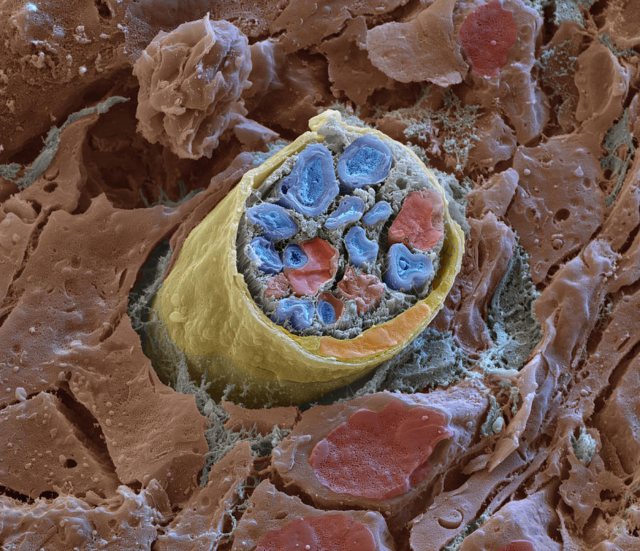 Peripheral Nerve Breakage, Sem #1 Photograph by Eye Of Science