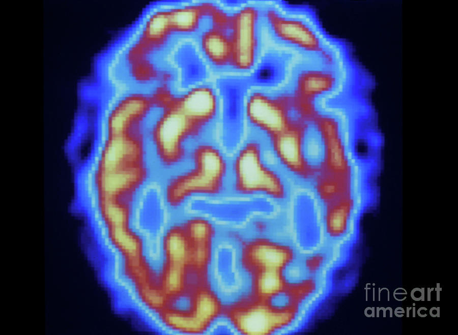 Pet Scan Of Brain Of Normal Subject #1 Photograph by Tim Beddow/science Photo Library