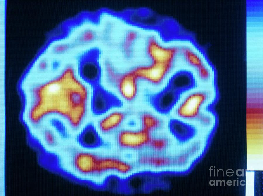 Pet Scan (temporal) Of Carbon Monoxide Poisoning #1 Photograph by Tim Beddow/science Photo Library