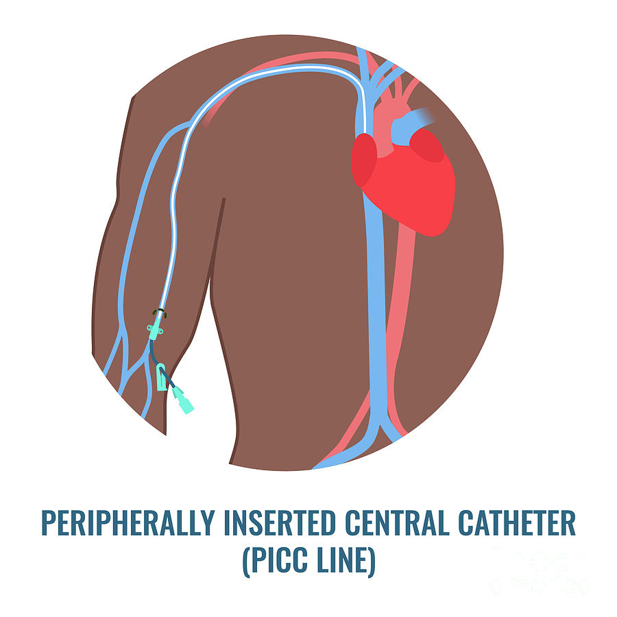 Picc Intravenous Device Photograph by Art4stock/science Photo Library ...