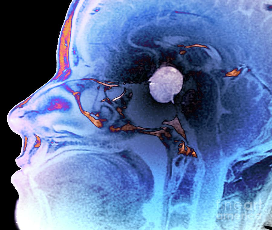 Pituitary Macroadenoma #1 by Zephyr/science Photo Library