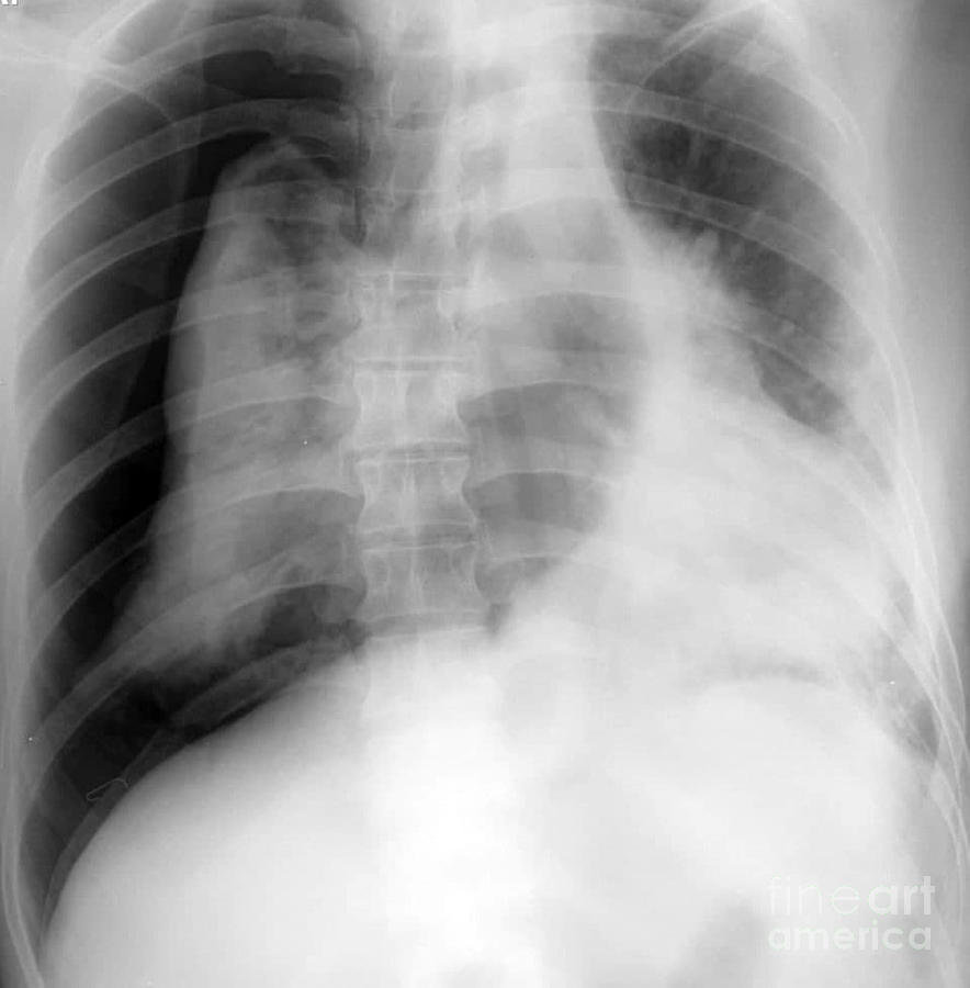 Pneumothorax #1 Photograph by Rajaaisya/science Photo Library