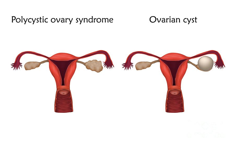 Polycystic Ovary Syndrome Photograph by Veronika Zakharova/science ...