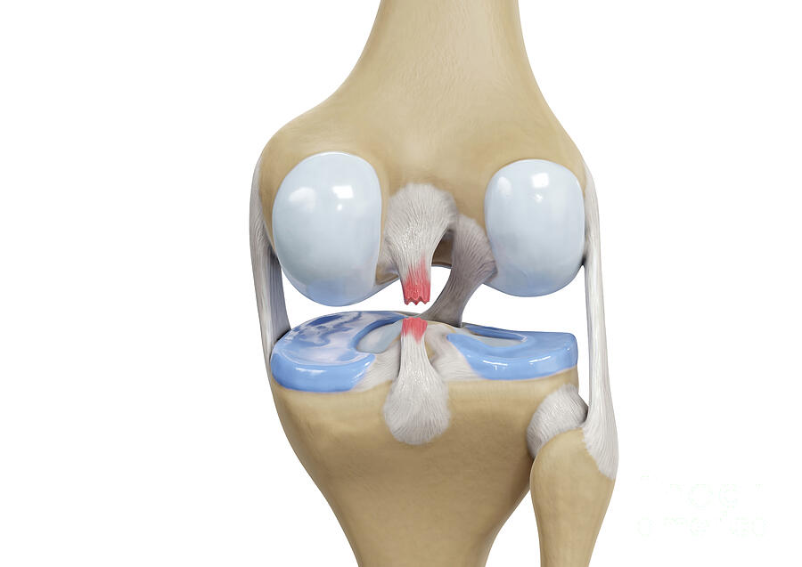 Posterior Cruciate Ligament Tear #1 Photograph by Medical Graphics/michael Hoffmann/science Photo Library Posterior Cruciate Ligament Tear #1 Photograph by Medical Graphics/michael Hoffmann/science Photo Library