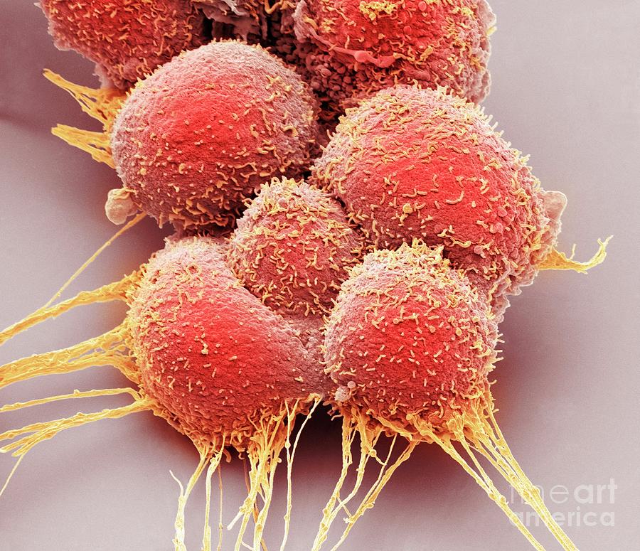 Prostate Cancer Cells Photograph By Steve Gschmeissnerscience Photo Library Fine Art America 8093