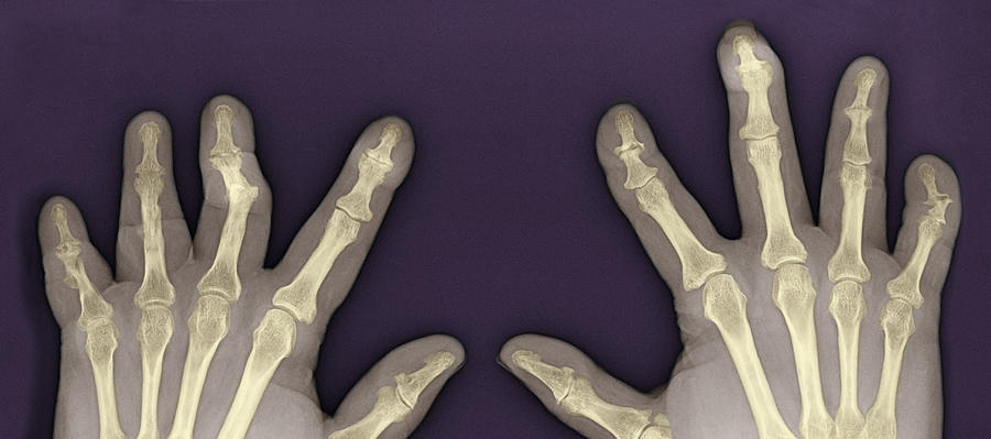 Psoriatic Arthritis, X-ray #1 Photograph by Steven Needell