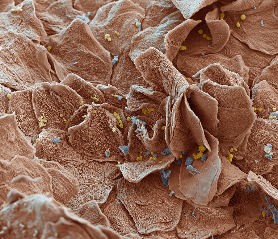 Psoriatic Skin With Yeast Infection, Sem #1 Photograph by Meckes/ottawa