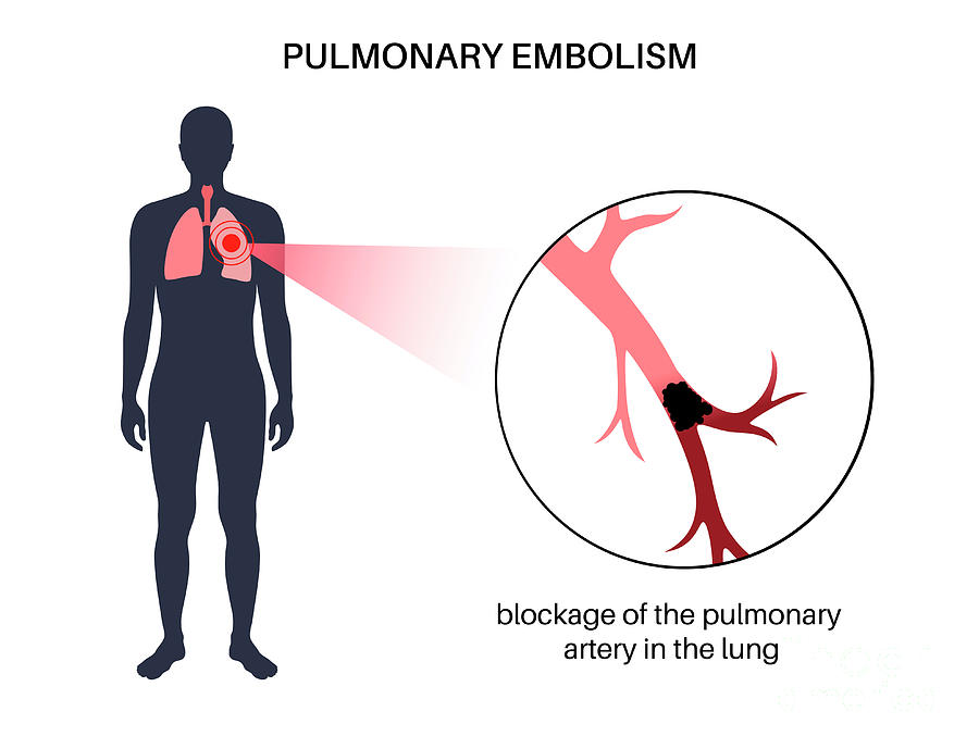 Pulmonary Embolism Photograph by Pikovit / Science Photo Library - Fine ...