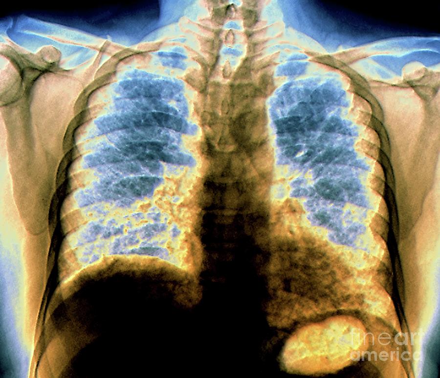 Pulmonary Fibrosis Photograph by Zephyr/science Photo Library - Fine ...