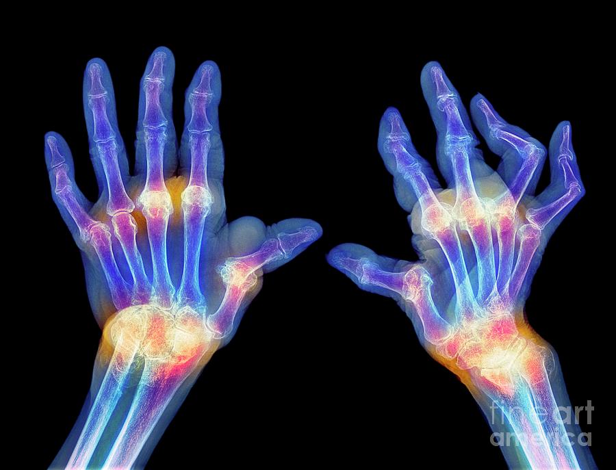 Rheumatoid Arthritis Of The Hands #1 Photograph by Science Photo Library