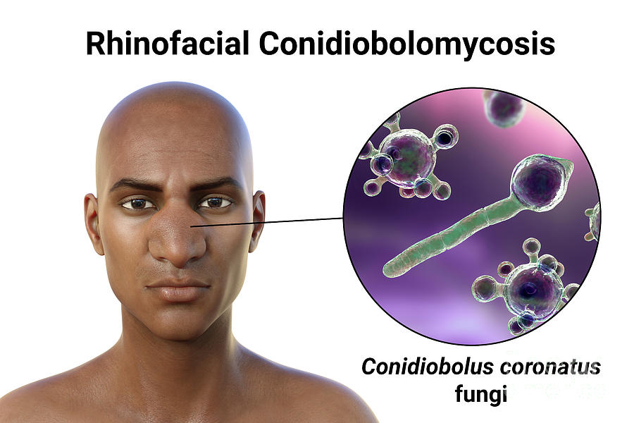 Rhinofacial Conidiobolomycosis And Fungus Photograph by Kateryna Kon ...