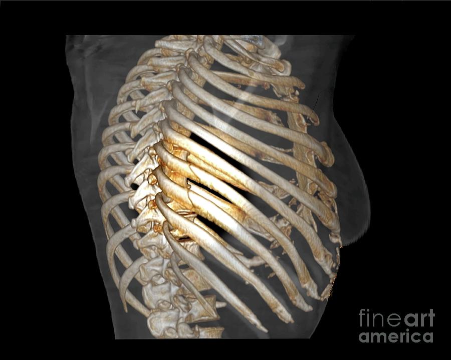 Disease Photograph - Rib Fractures #1 by Zephyr/science Photo Library