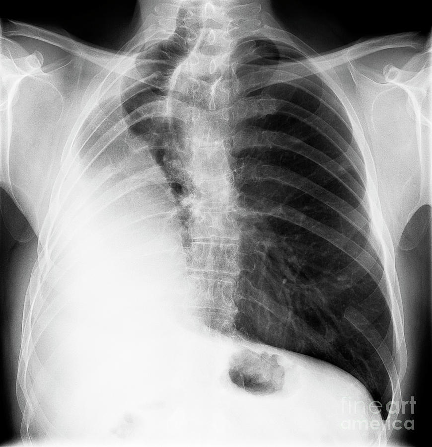 Right Pneumonectomy Photograph by Science Photo Library - Fine Art America