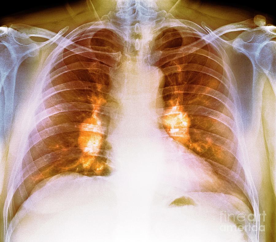 Sarcoidosis Of The Lungs Photograph By Dr P Marazzi Science Photo