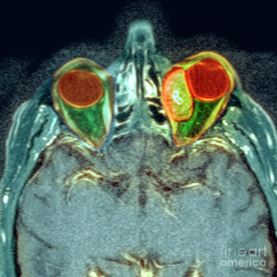 Secondary Cancer Photograph By Simon Frasernewcastle Hospitals Nhs Trustscience Photo Library 3161