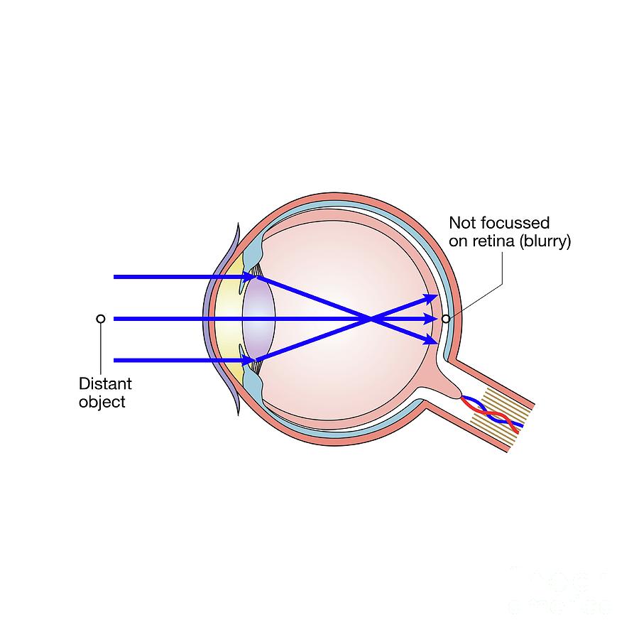 Short-sightedness Photograph by Science Photo Library - Fine Art America