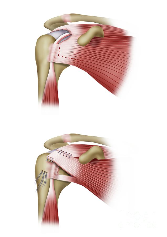 Shoulder Muscles Surgery Photograph by Maurizio De Angelis/science ...